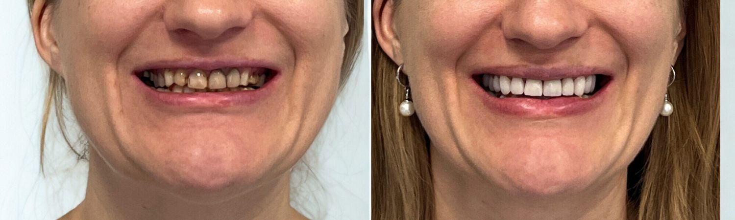 risultato prima e dopo faccette dentali