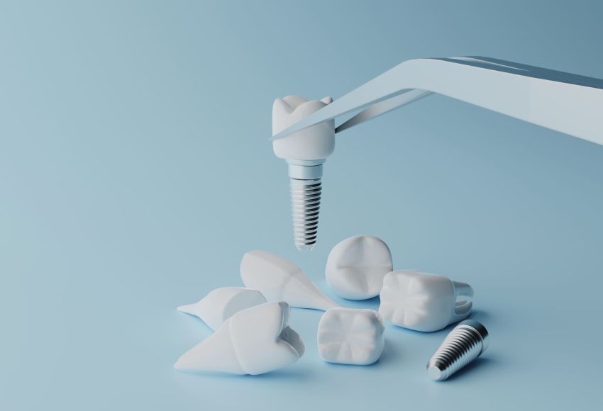 Falsi miti: implantologia dentale
