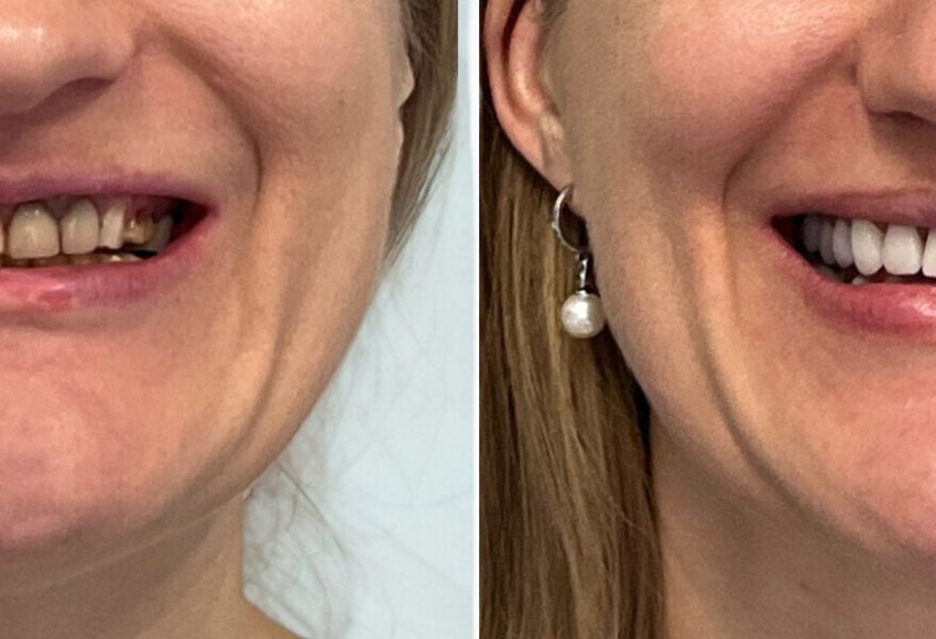 risultato prima e dopo faccette dentali