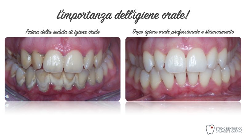 Prima e dopo igiene sbiancamento