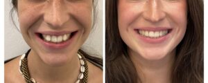 prima e dopo trattamento con allineatori trasparenti