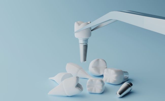 Falsi miti: implantologia dentale